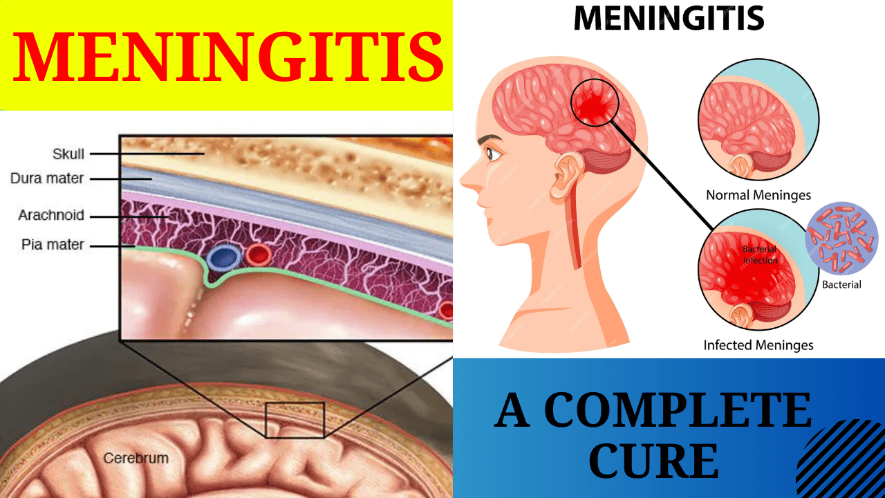 meningitis ppt