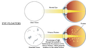 Dry Eye Floaters