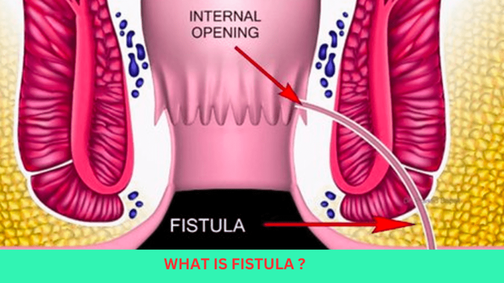 How can I close my fistula without surgery How can I close my fistula without surgery