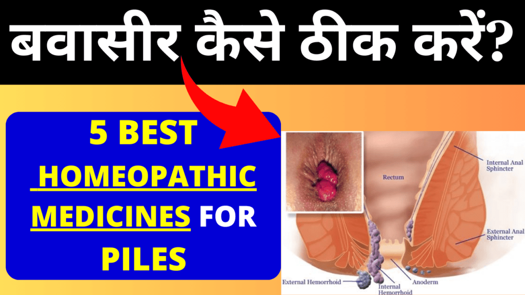 How to remove Piles without Surgery How to remove Piles without Surgery