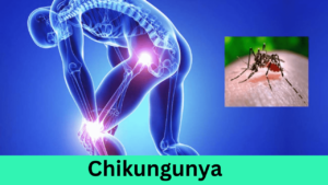 Chikungunia