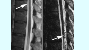 Spinal Dural Arteriovenous Fistula shows in CT Scan