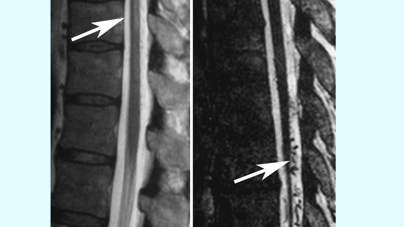 Spinal Dural Arteriovenous Fistula shows in CT Scan