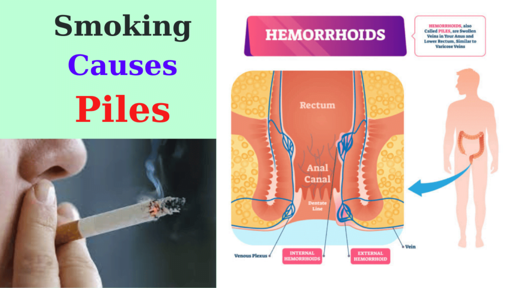 Smoking Causes Piles: Is Smoking Good For Piles Smoking Causes Piles (hemorrhoids)