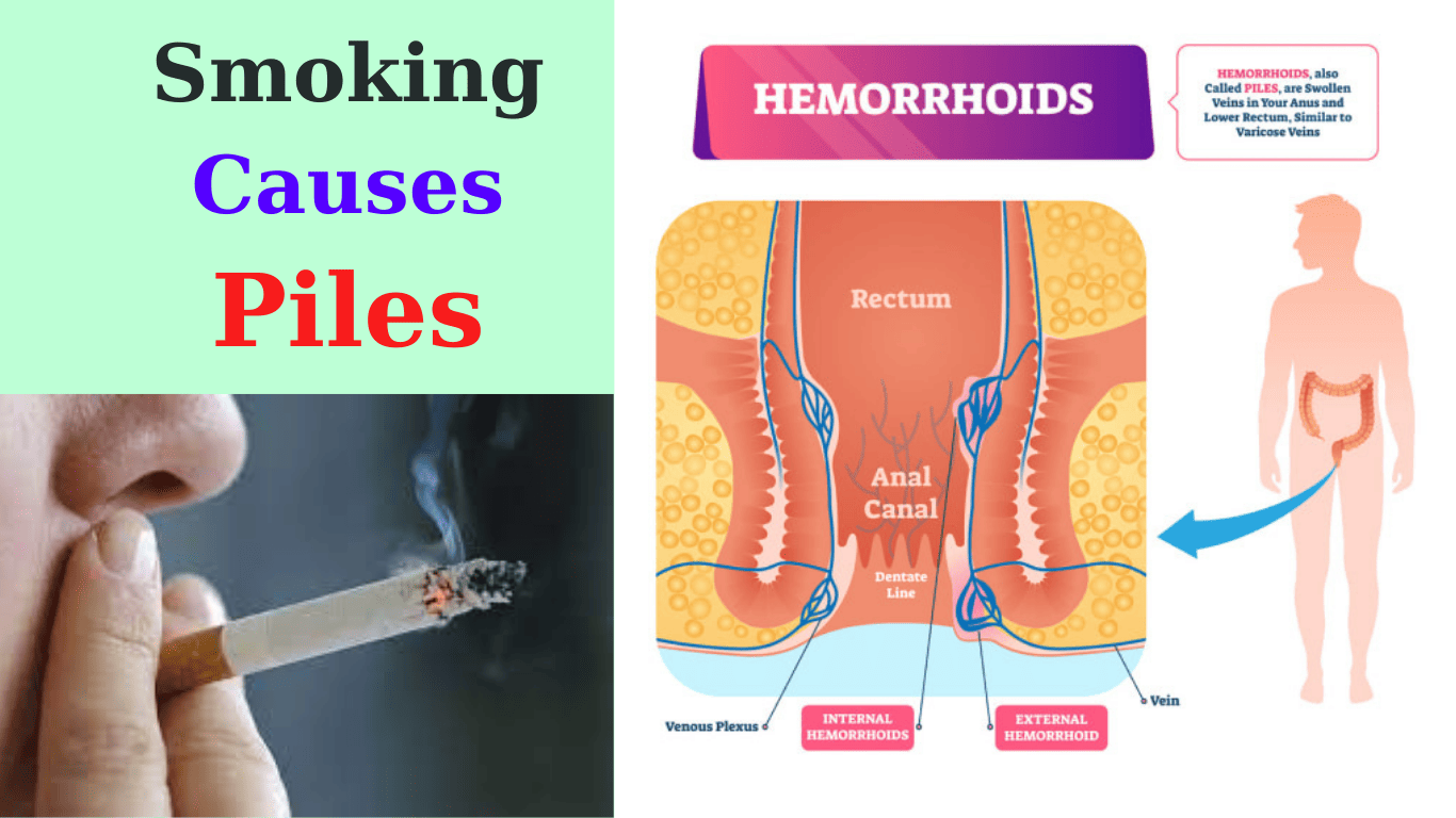 smoking causes piles