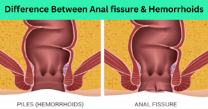 Anal Fissure vs. Hemorrhoids: How to Differentiate and Treat