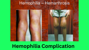Hemophilia affects the knees called Hemarthrosis