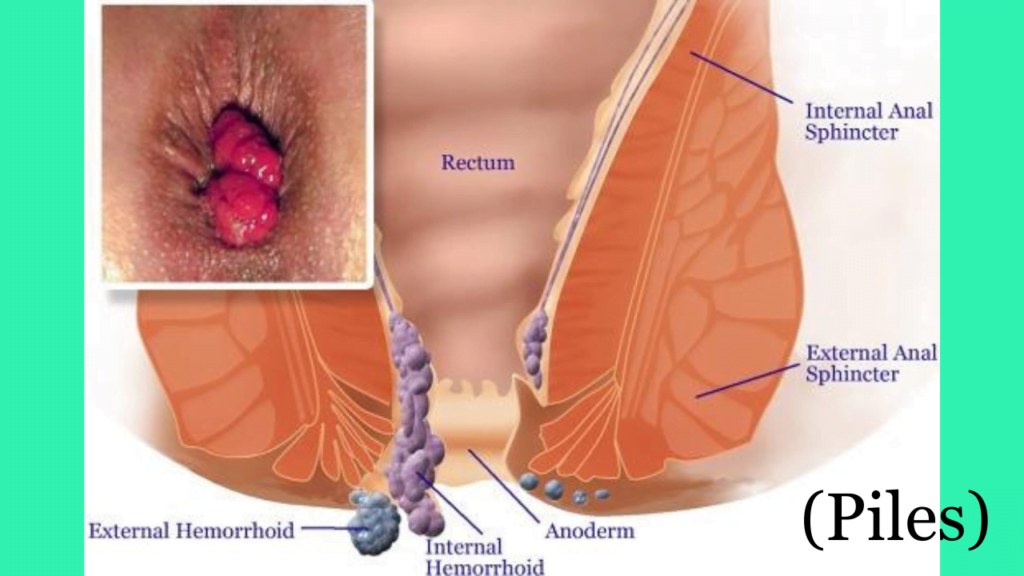 पाइल्स के लक्षण और इलाज हिंदी Piles Symptoms with protruding external and internal, पाइल्स के लक्षण और इलाज हिंदी
