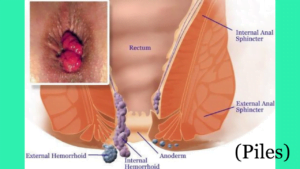 Piles protruding external and internal