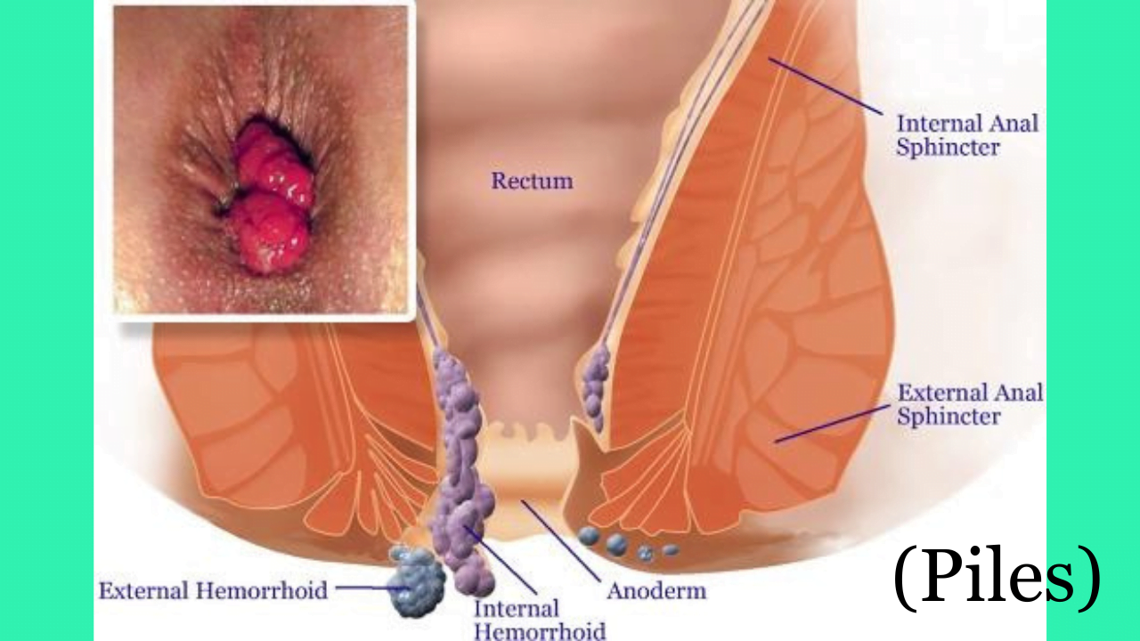 Piles protruding external and internal