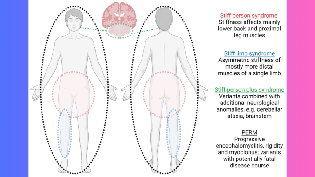 Stiff-Person Syndrome, Revealing Celine Dion's Lack of Muscle Control Stiff-Person Syndrome, Revealing Celine Dion's Lack of Muscle Control