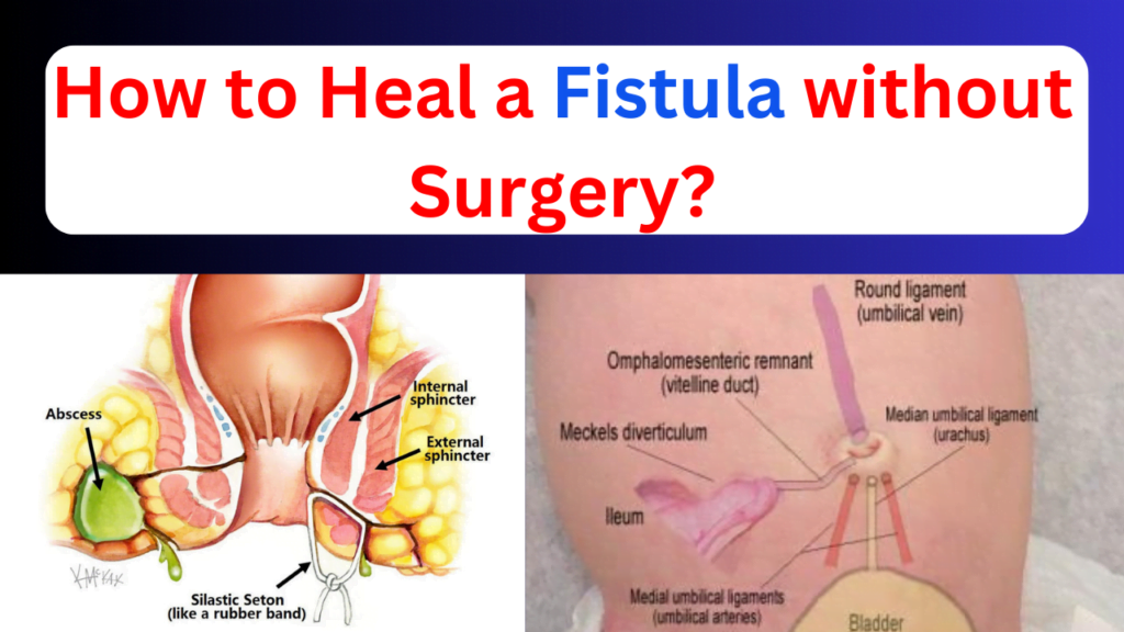 How to Heal a Fistula Without Surgery: 5 Natural Ways How to heal a fistula without surgery related pics of anal fistula and umbilical fistula