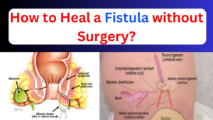 How to heal a fistula without surgery