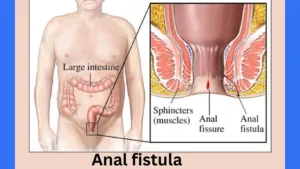 anal fistula in hindi with a man
