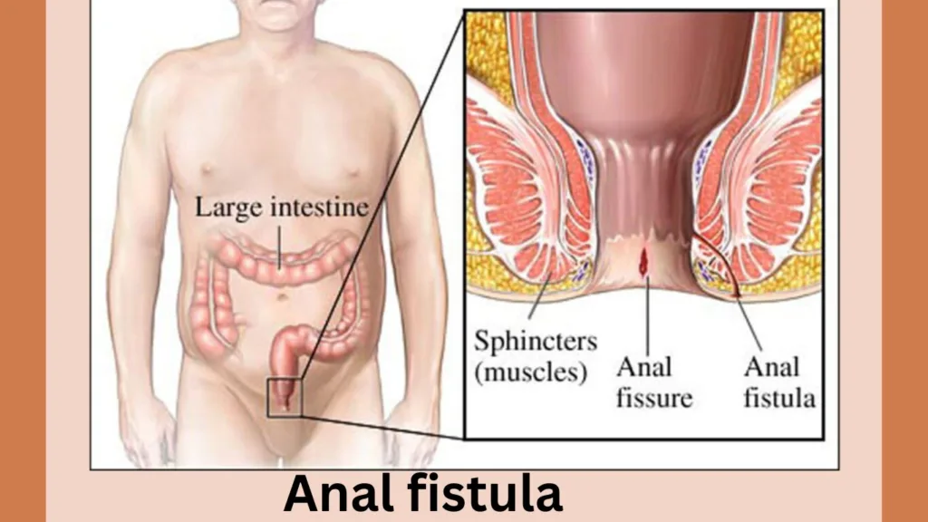 भगन्दर(Fistula) के 9 लक्षण और इलाज: Anal fistula in hindi Cure By Homeopathy Easily Anal fistula in hindi and a man show anal fissure and fistula