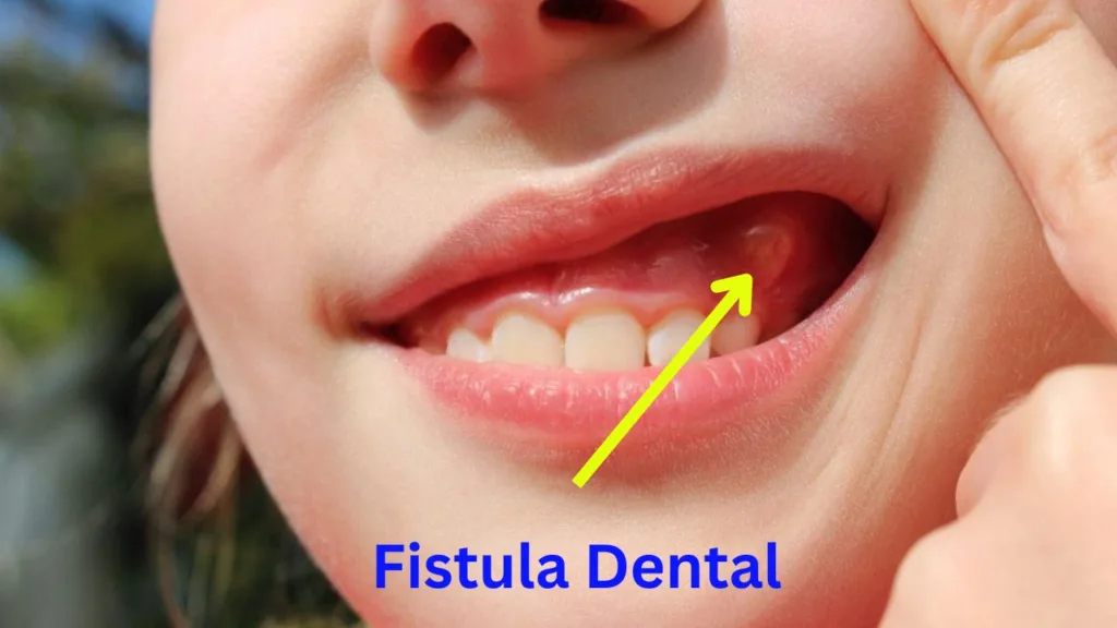 Fistula Dental: It's Causes, Symptoms and 4 Easy Treatments fistula dental
