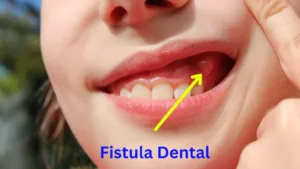 fistula dental