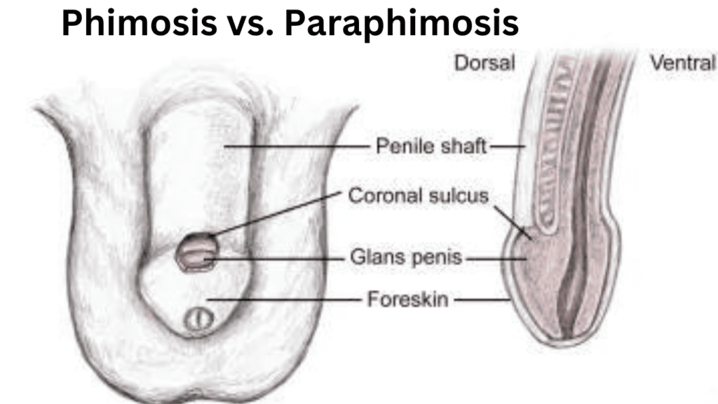 Phimosis vs. Paraphimosis: 8 Main Symptoms to be Removed Phimosis vs. Paraphimosis