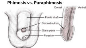 phimosis vs. paraphimosis