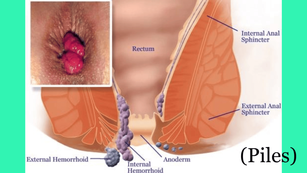 पाइल्स का इलाज हिंदी: How To Cure Piles In Hindi Easily पाइल्स का इलाज हिंदी: How To Cure Piles In Hindi Easily