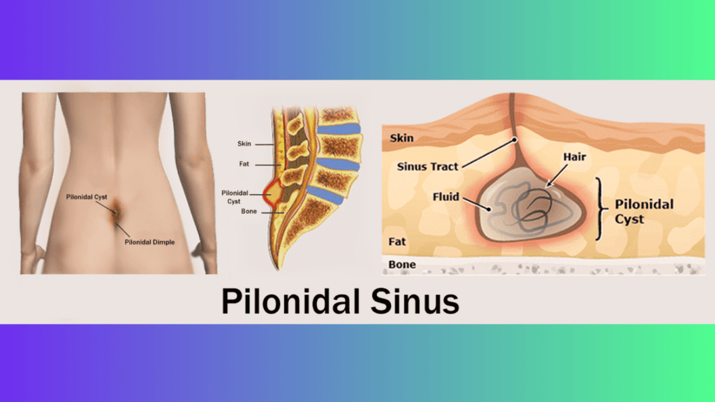 Pilonidal Sinus Treatment Without Surgery: 13 Best Tips To Cure Easily Pilonidal Sinus treatment without surgery