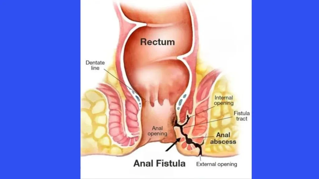 Anal Fistula Pictures, Symptoms, Causes, and 10 Best Homeopathic Remedies Anal Fistula Pictures