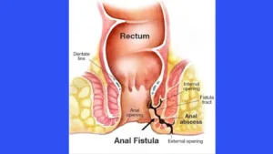Anal Fistula Pictures