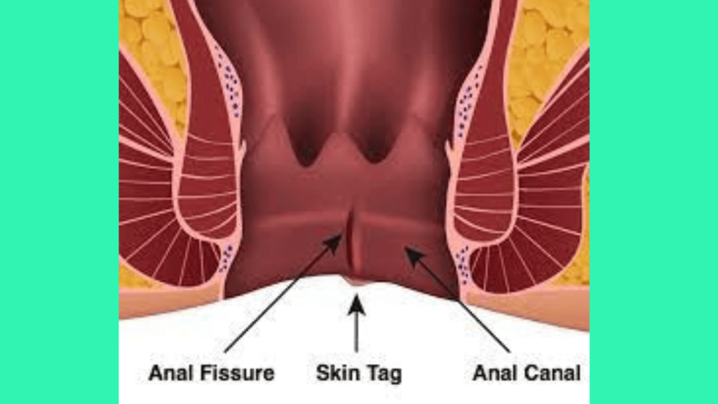 Anal Fissures: 10 Best Homeopathic Mesicines to Cure Easily Anal Fissures