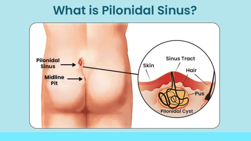 Pilonidal Sinus Treatment Without Surgery: 13 Best Tips To Cure Easily Pilonidal Sinus Treatment Without Surgery an overview