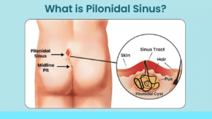 pilonidal cyst treatment without surgery