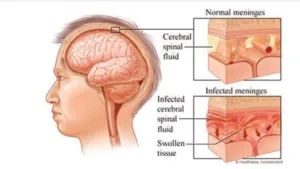 Pediatric Meningitis ppt