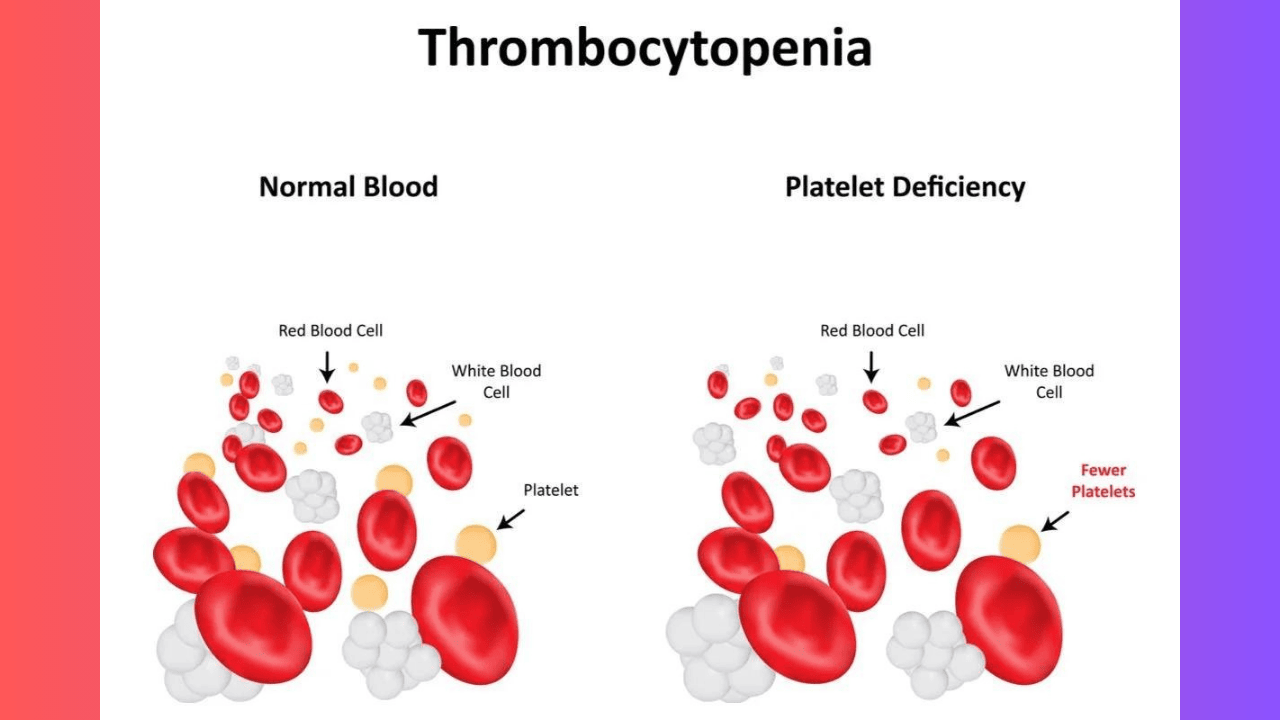 Thrombocytopenia