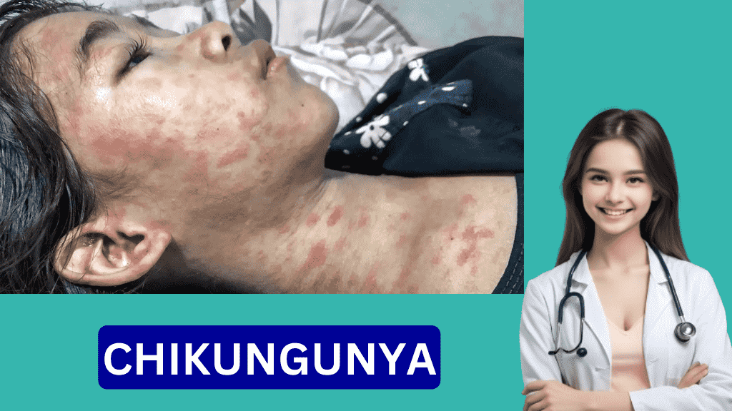 Chikungunya Rash Images