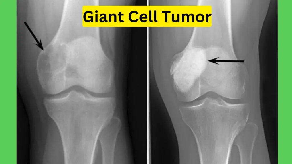 Giant Cell Tumor Precautions: 10 Things To Focus For Easily Cure Giant Cell Tumor Precautions
