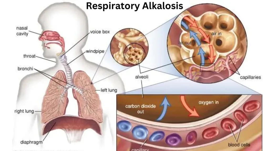 Respiratory Alkalosis ICD 10: How To Best Optimize Health Easily Respiratory Alkalosis ICD 10