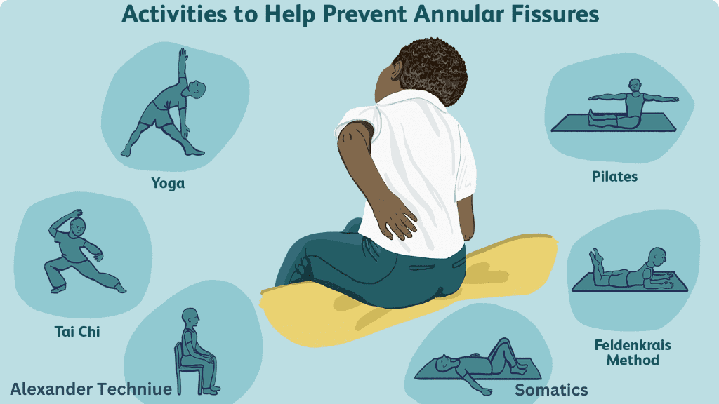 Treatment for Annular Fissures