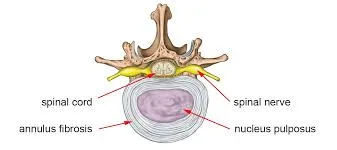 Treatment for Annular Fissures Treatment for Annular Fissures
