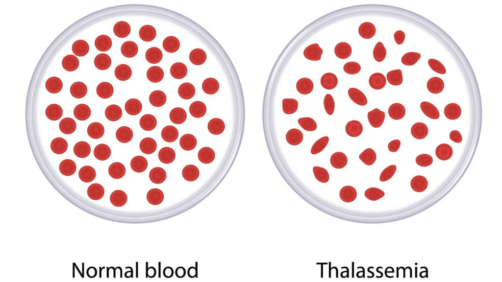 Thalassemia Homeopathy Treatment Thalassemia Homeopathy Treatment
