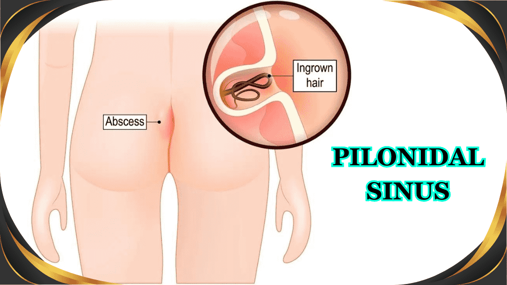 Pilonidal Sinus Disease Treatment