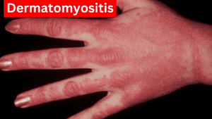 Dermatomyositis