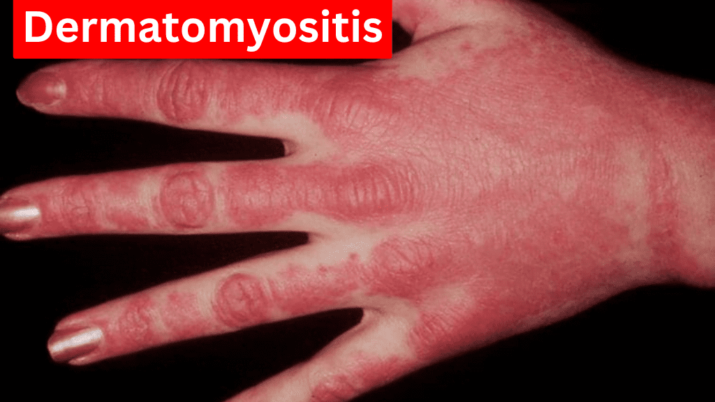 Dermatomyositis