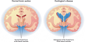 Huntington's Disease